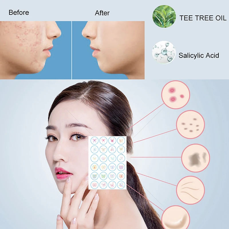 96Pcs Butterfly Acne Patch